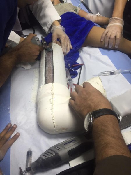 فك احتجاز قدم طفل بالخبر