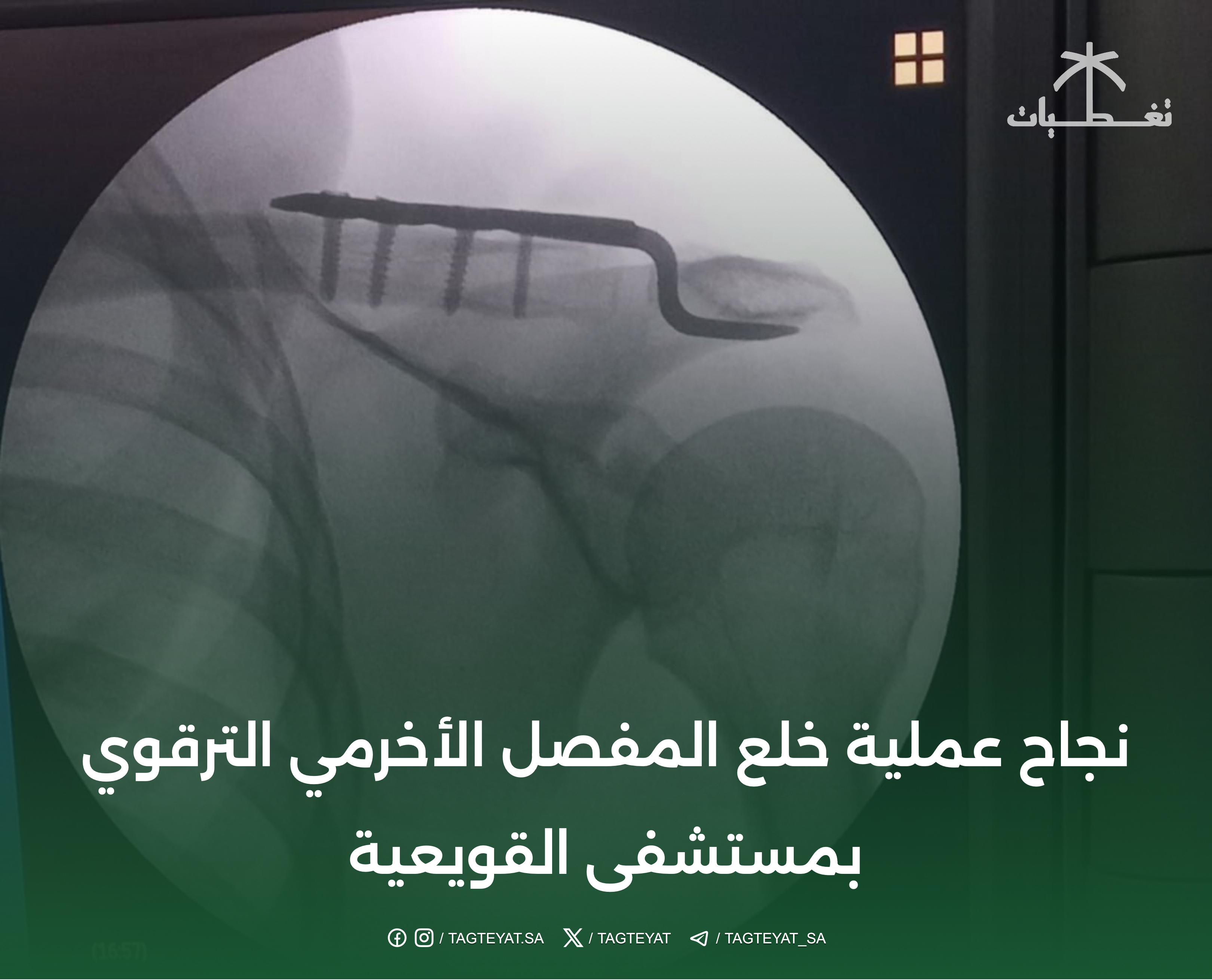 نجاح عملية خلع المفصل الأخرمي الترقوي بمستشفى القويعية